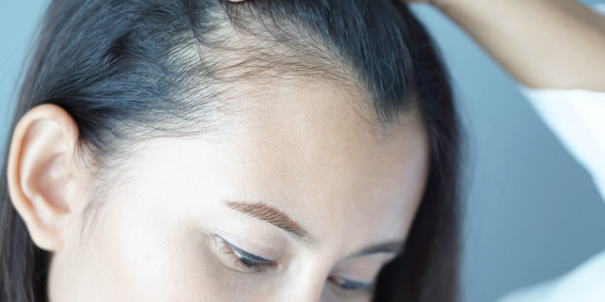Hair Growth Treatment Singapore: The Best Solutions for Healthier Hair